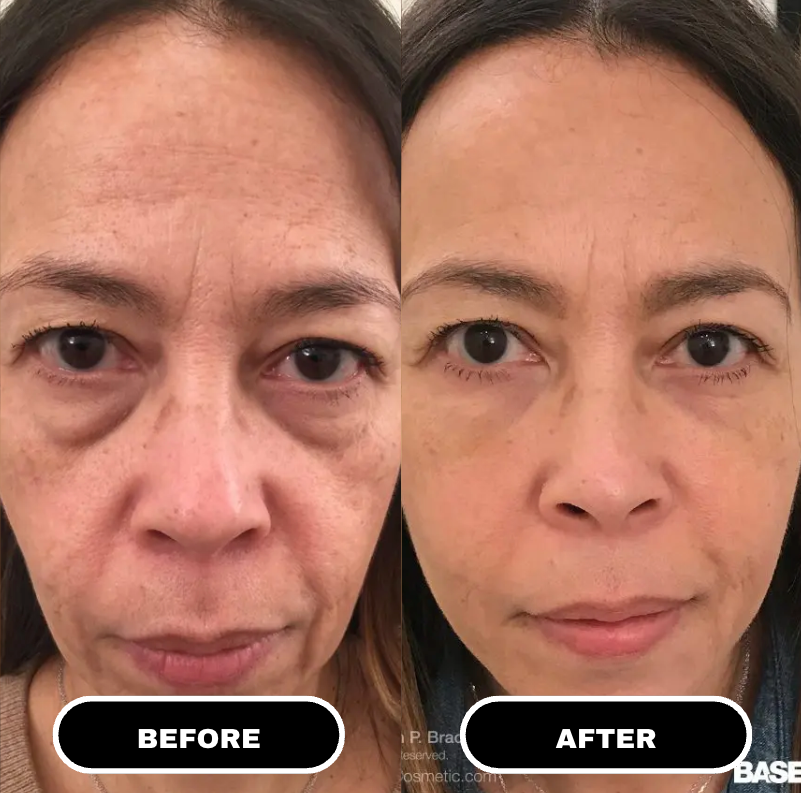 Microcrystalline Lifting Patches