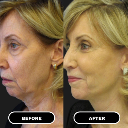 Microcrystalline Lifting Patches