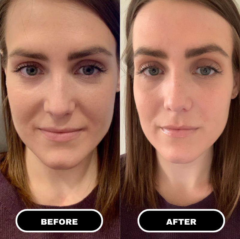 Microcrystalline Lifting Patches